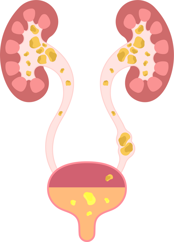 ureter urine pain kidney tract stone system test treat bladder Glomerulonephritis Urology damage dialysis nephrology transplant renal calculi uric acid